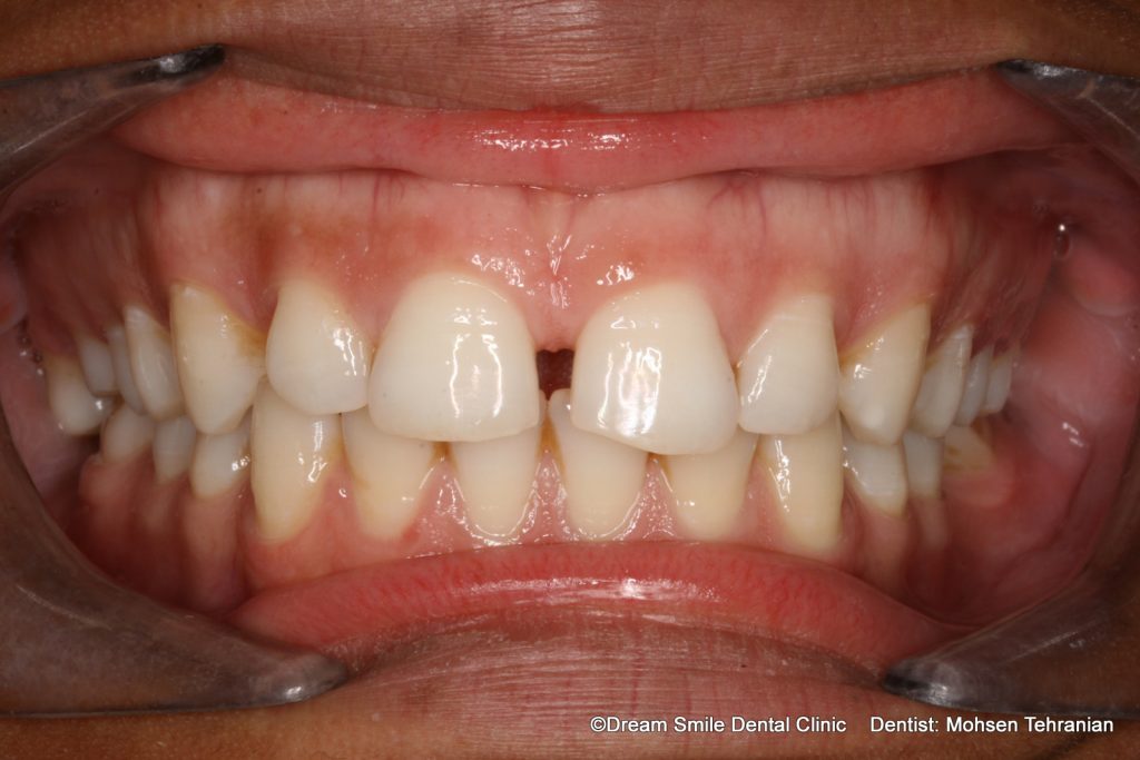 Gappy Teeth 1 Dream Smile Dental Clinic 