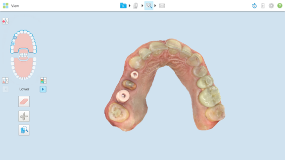 Dream Smile Dental - Impressions for the Final Restoration