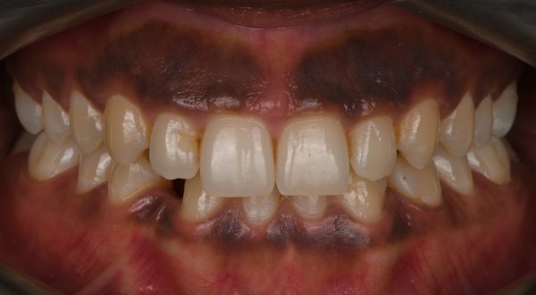 Dream Smile Dental - Laser Gum Depigmentation Patient Before