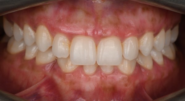 Dream Smile Dental - Laser Gum Depigmentation Patient After
